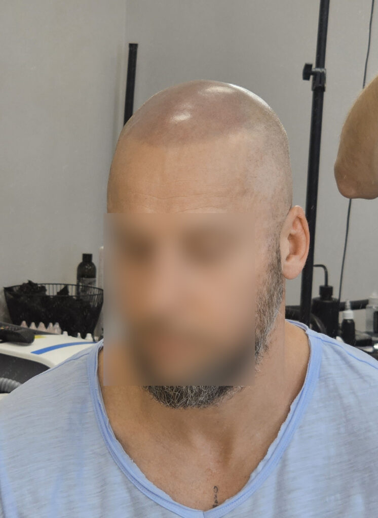 трихопигментация-волос-до-после-scalpmicropigmentation-befora-after-krasnodar-smpstudio-ru-52_1
