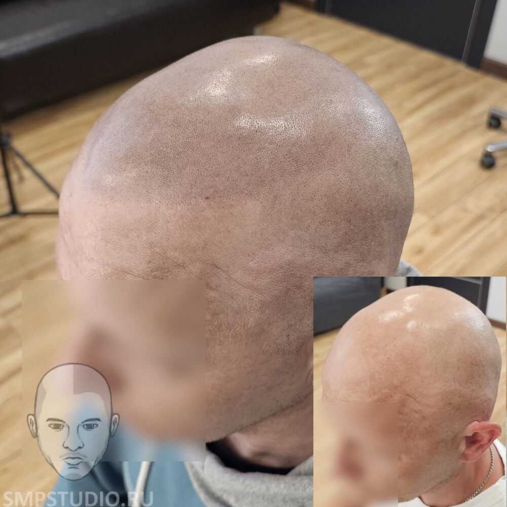 трихопигментация-волос-до-после-scalpmicropigmentation-befora-after-krasnodar-smpstudio-ru-53