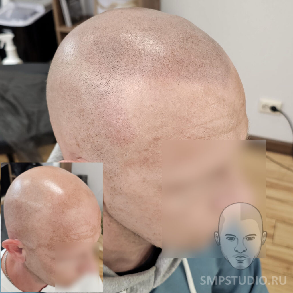 трихопигментация-волос-до-после-scalpmicropigmentation-befora-after-krasnodar-smpstudio-ru-53_2