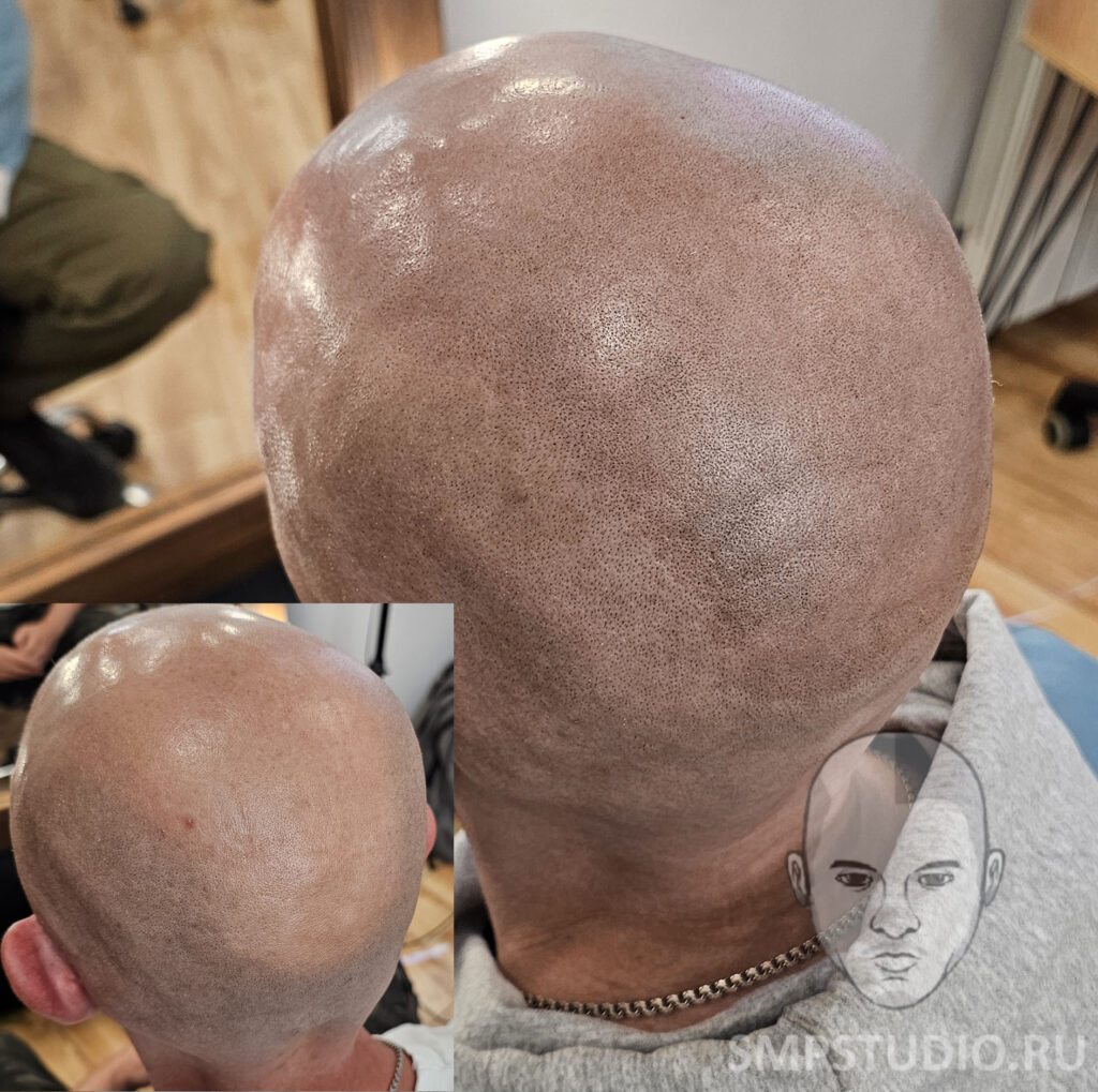трихопигментация-волос-до-после-scalpmicropigmentation-befora-after-krasnodar-smpstudio-ru-53_3