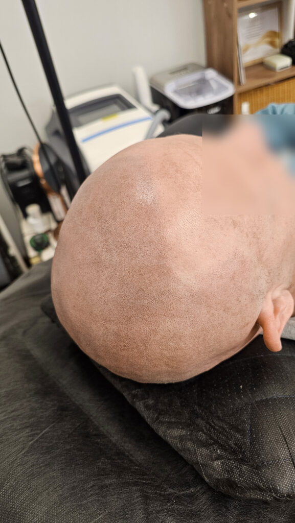 трихопигментация-волос-до-после-scalpmicropigmentation-befora-after-krasnodar-smpstudio-ru-53_4_6