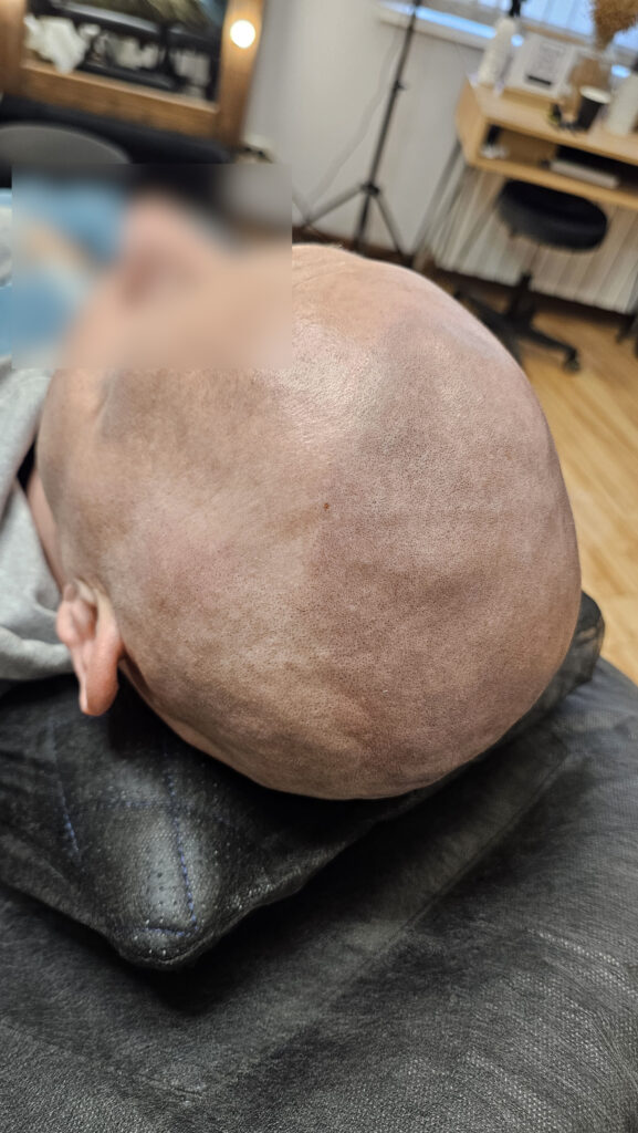 трихопигментация-волос-до-после-scalpmicropigmentation-befora-after-krasnodar-smpstudio-ru-53_5