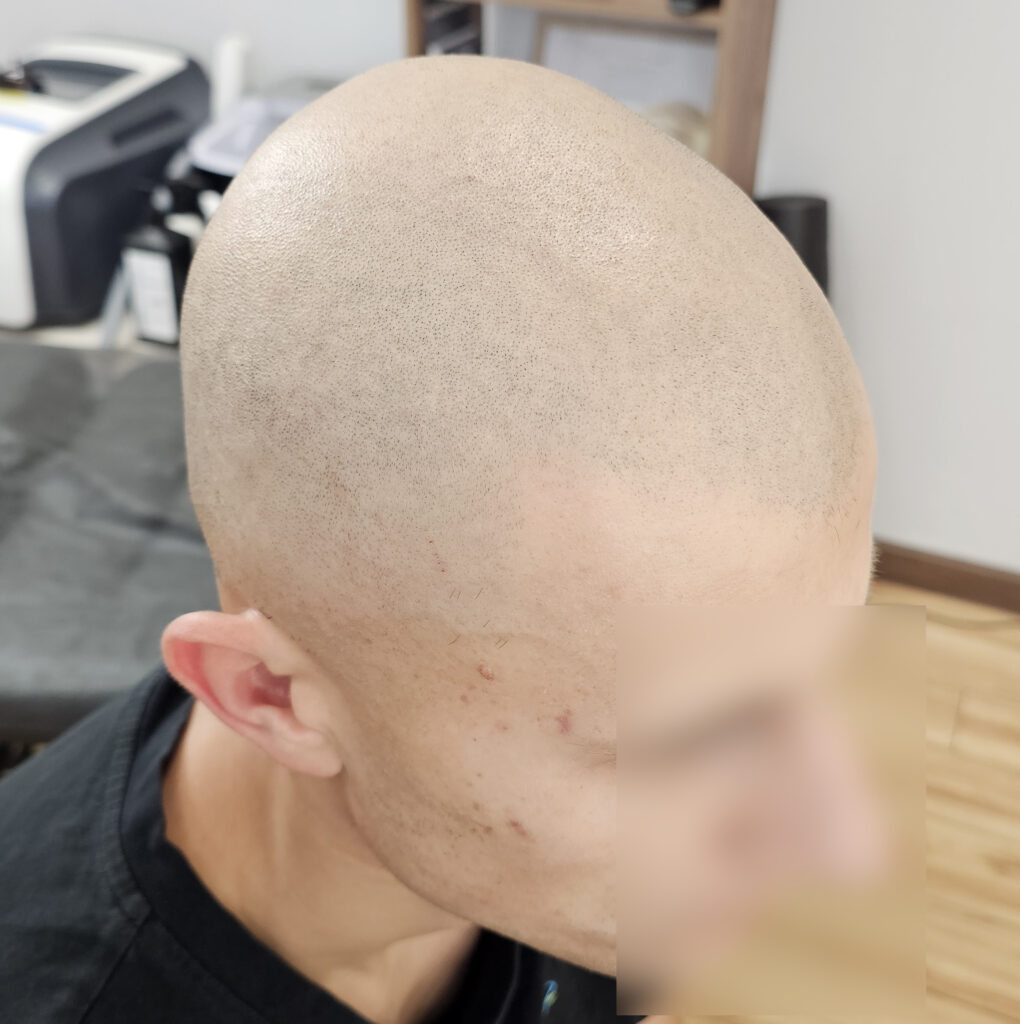 трихопигментация-волос-до-после-зажившая-2-процедура-scalpmicropigmentation-befora-after-healed-krasnodar-smpstudio-ru-50_1