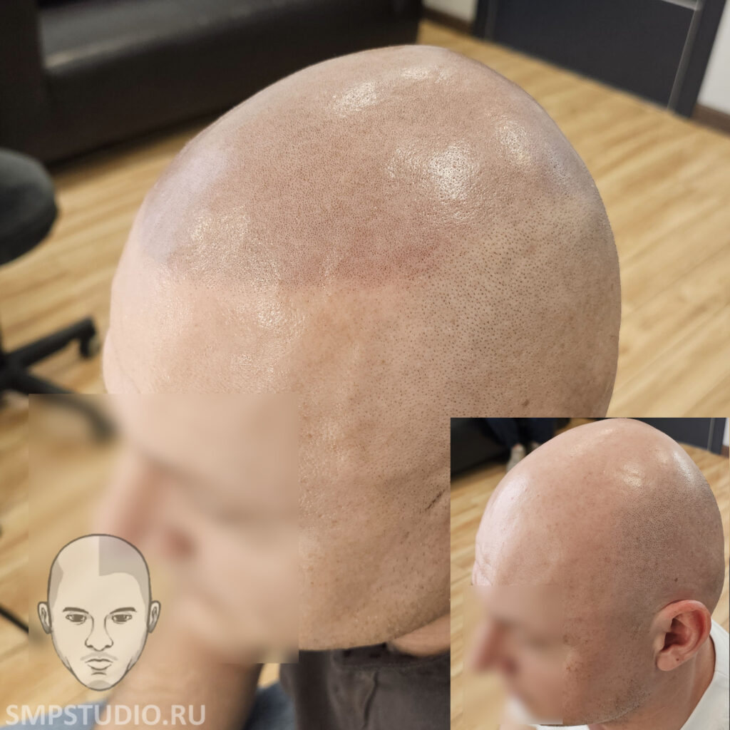 трихопигментация-волос-до-после-scalpmicropigmentation-befora-after-krasnodar-smpstudio-ru-54