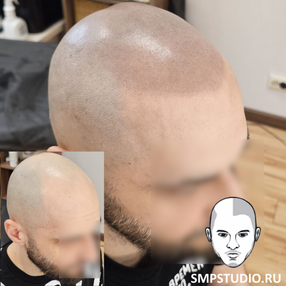трихопигментация-волос-до-после-scalpmicropigmentation-befora-after-krasnodar-smpstudio-ru-55-1