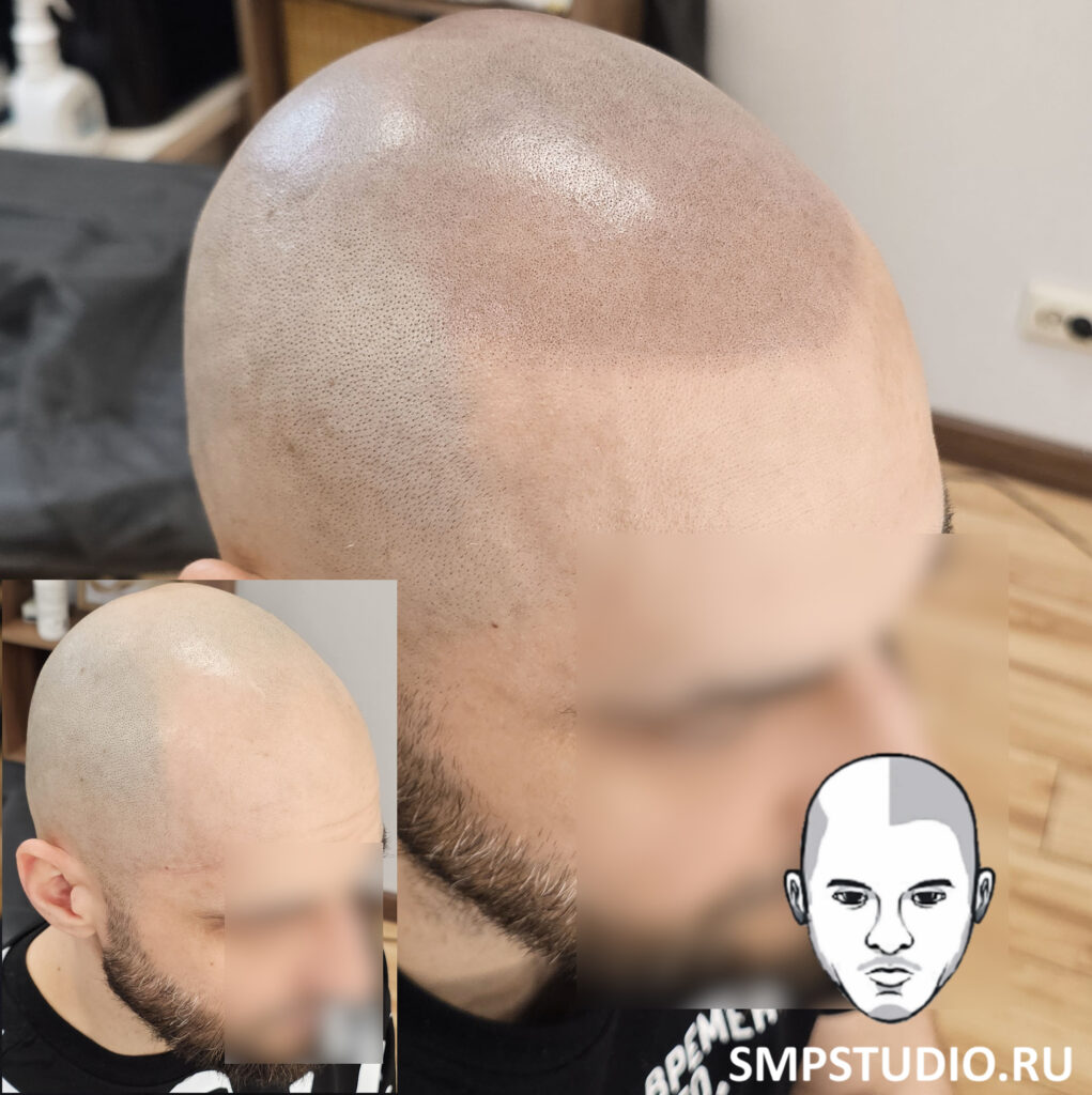 трихопигментация-волос-до-после-scalpmicropigmentation-befora-after-krasnodar-smpstudio-ru-55-1