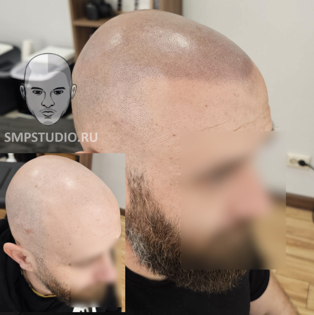 трихопигментация-волос-до-после-scalpmicropigmentation-befora-after-krasnodar-smpstudio-ru-55-1