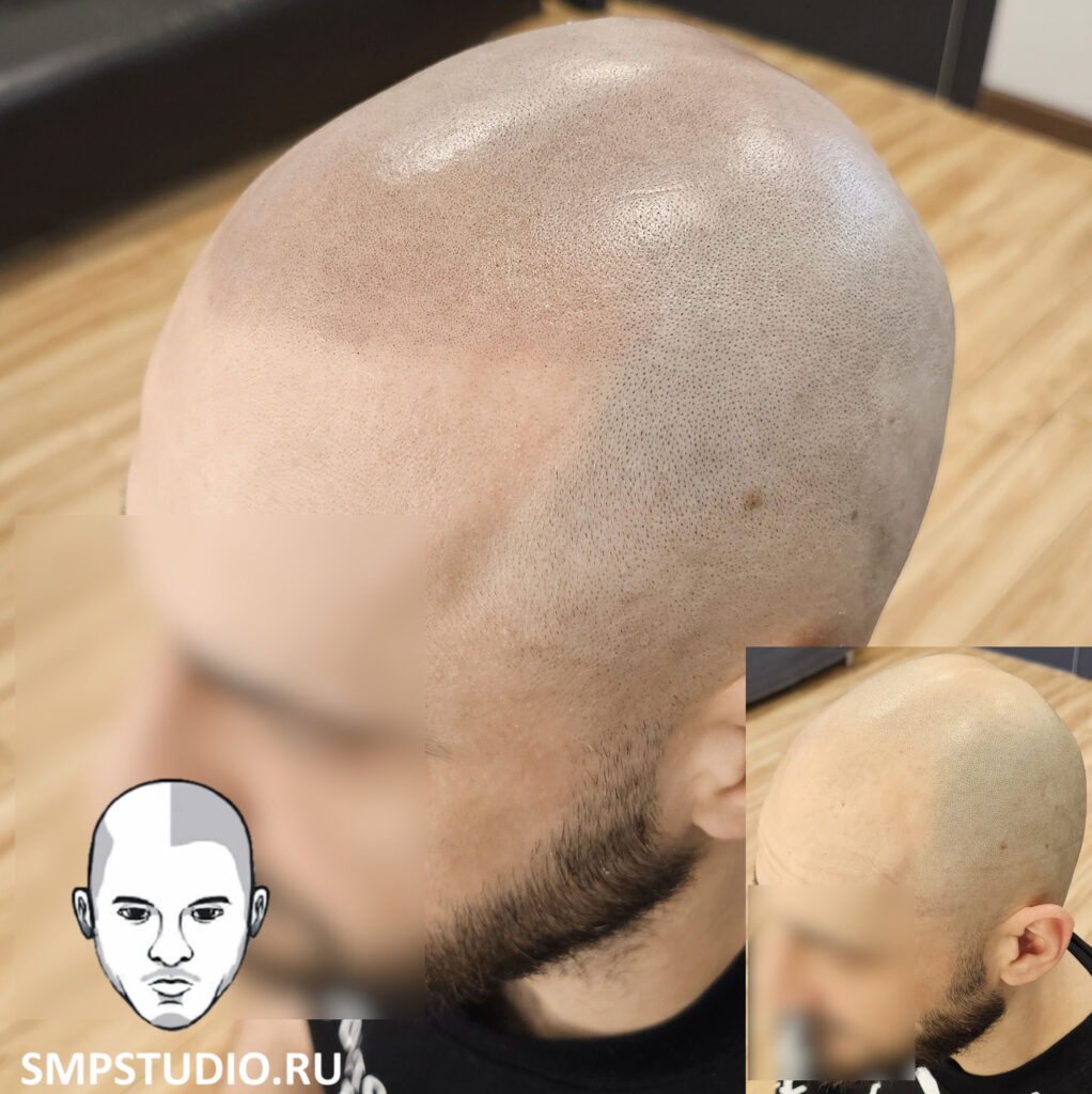 трихопигментация-волос-до-после-scalpmicropigmentation-befora-after-krasnodar-smpstudio-ru-55-1