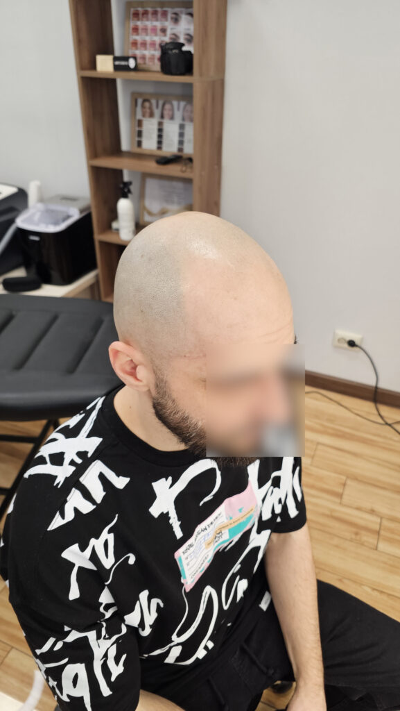 трихопигментация-волос-до-после-scalpmicropigmentation-befora-after-krasnodar-smpstudio-ru-55-1