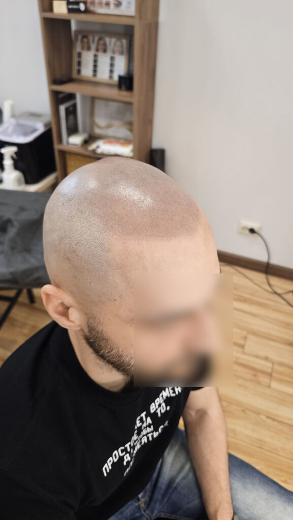 трихопигментация-волос-до-после-scalpmicropigmentation-befora-after-krasnodar-smpstudio-ru-55-1