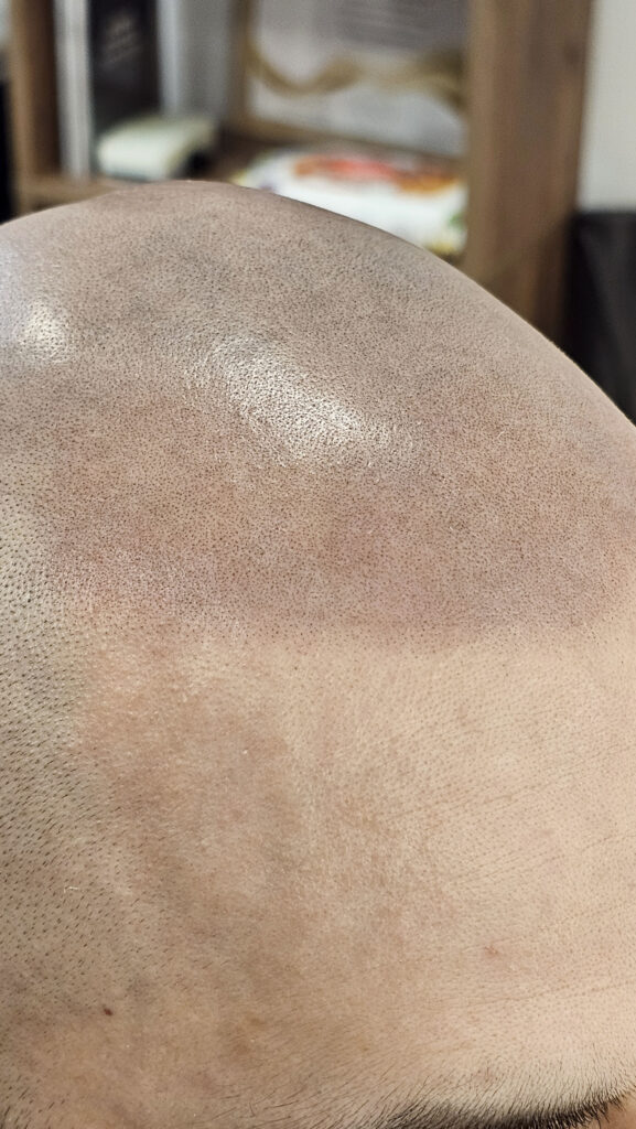 трихопигментация-волос-до-после-scalpmicropigmentation-befora-after-krasnodar-smpstudio-ru-55-1