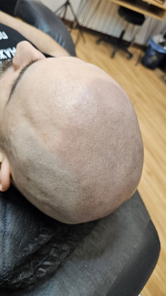 трихопигментация-волос-до-после-scalpmicropigmentation-befora-after-krasnodar-smpstudio-ru-55-1