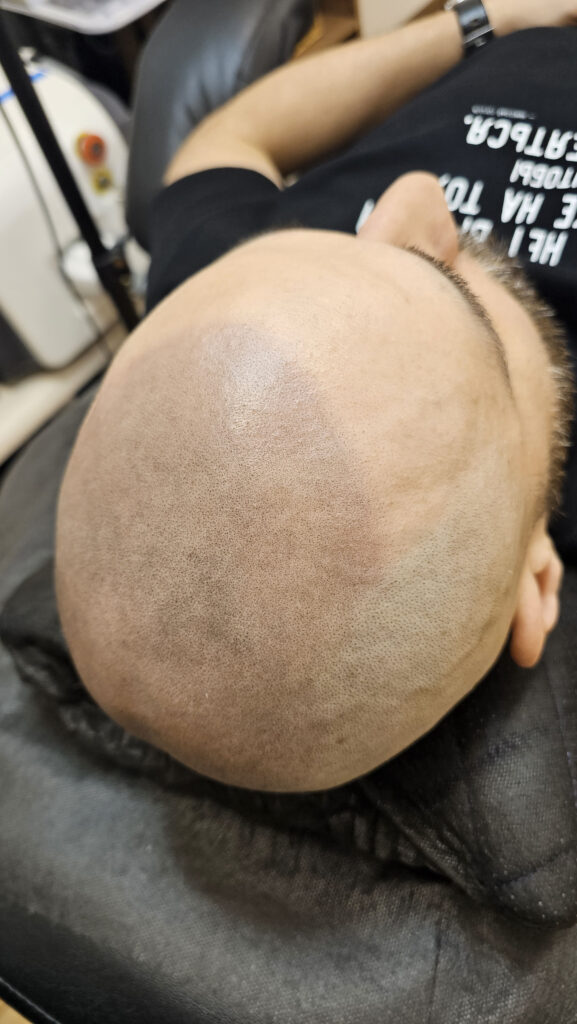 трихопигментация-волос-до-после-scalpmicropigmentation-befora-after-krasnodar-smpstudio-ru-55-1