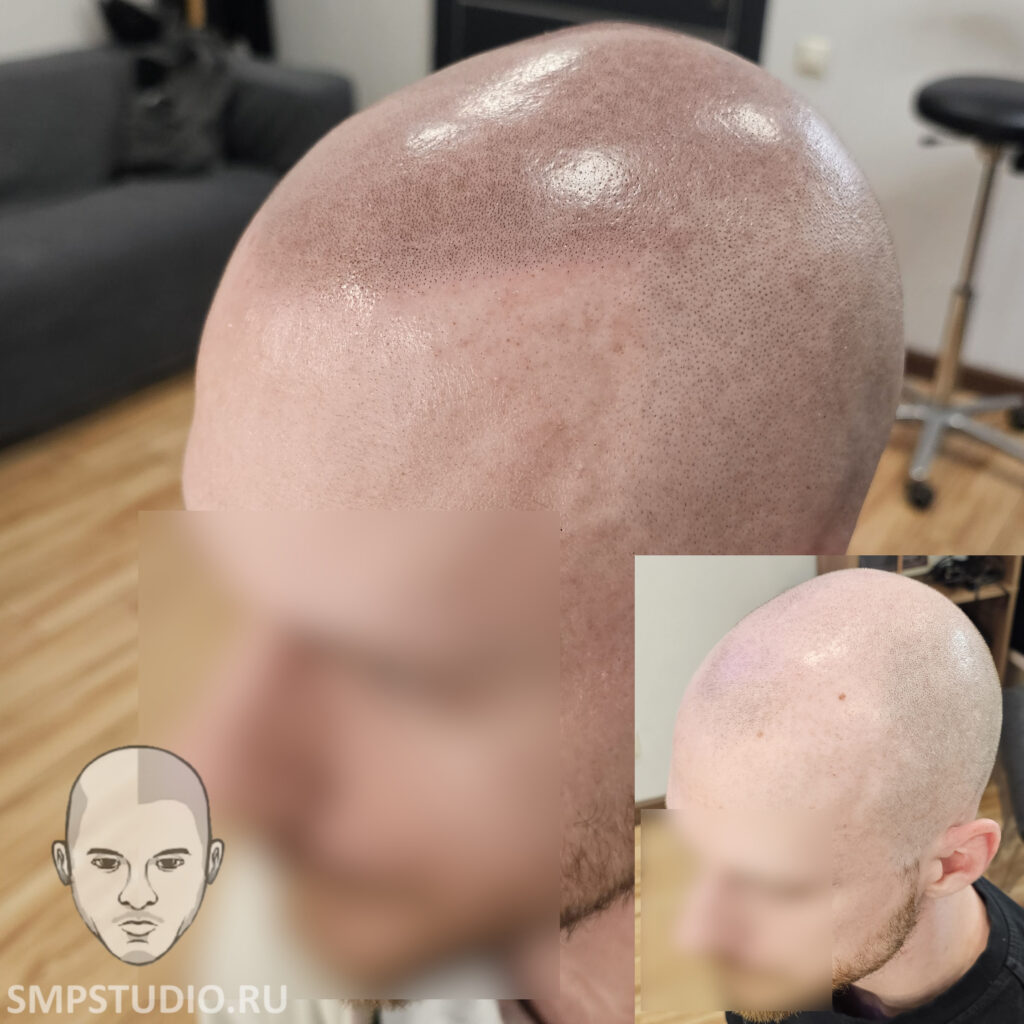 Трихопигментация волос до и после процедуры — scalp micropigmentation