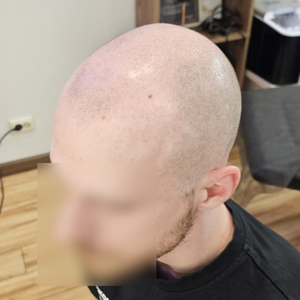 Трихопигментация волос до и после процедуры — scalp micropigmentation