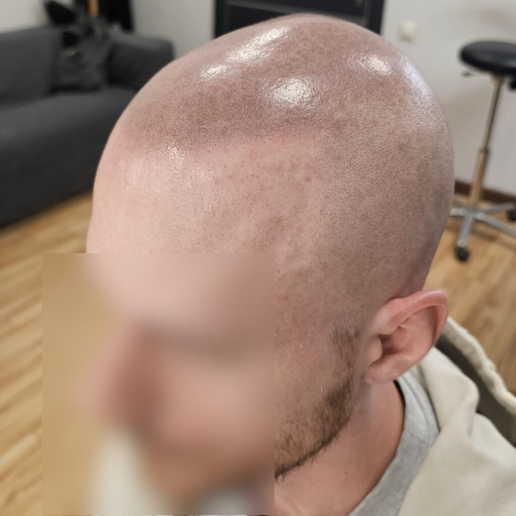 Трихопигментация волос до и после процедуры — scalp micropigmentation