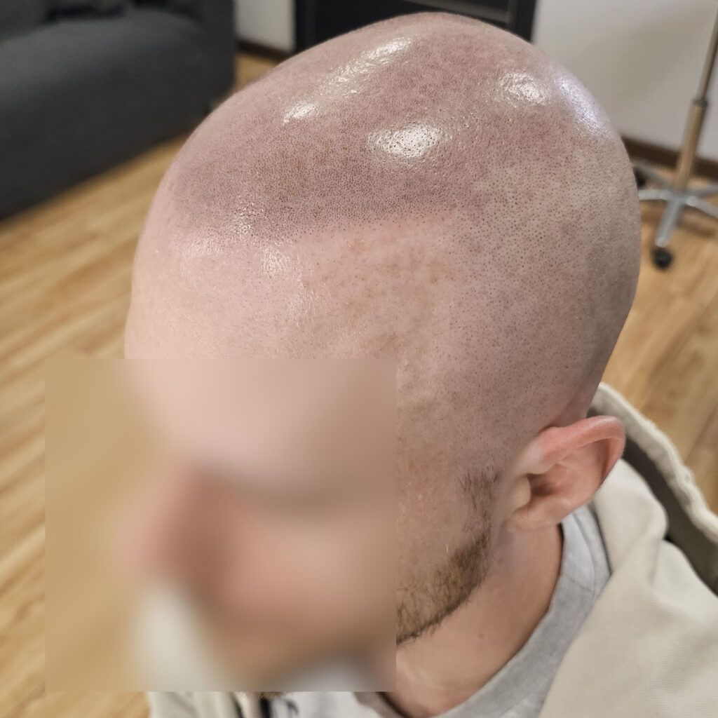 Трихопигментация волос до и после процедуры — scalp micropigmentation