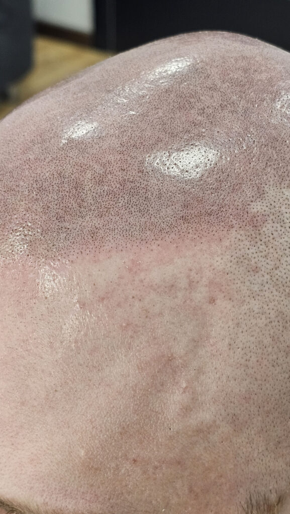 Трихопигментация волос до и после процедуры — scalp micropigmentation