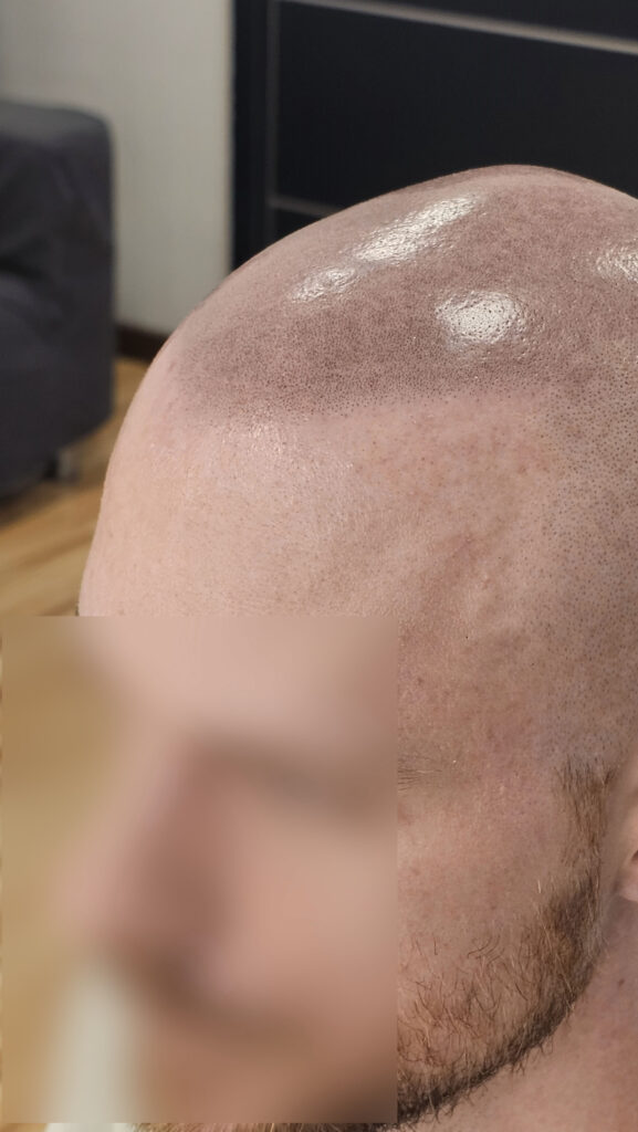 Трихопигментация волос до и после процедуры — scalp micropigmentation
