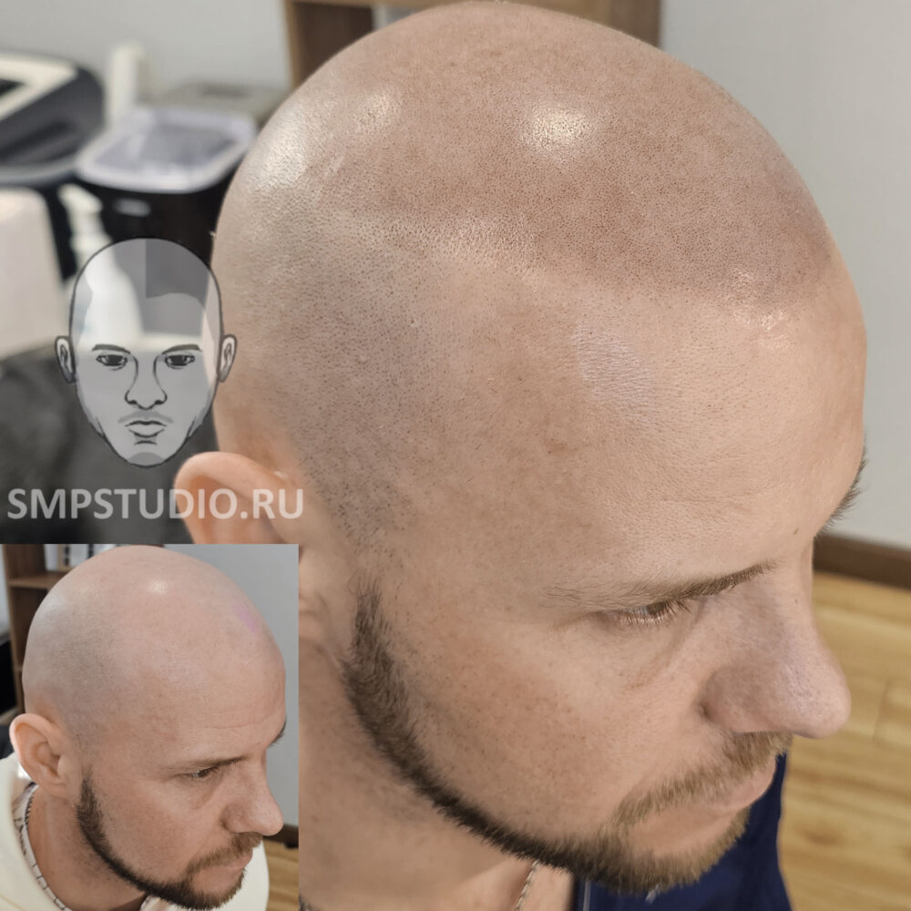Трихопигментация волос до и после процедуры — scalp micropigmentation