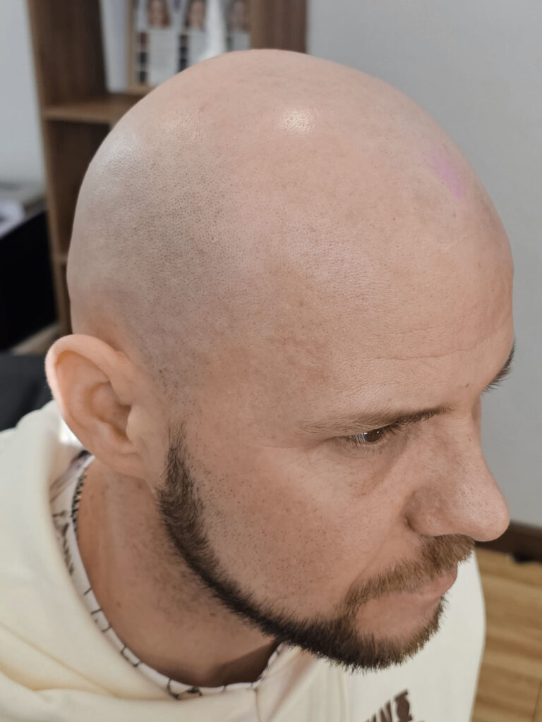 Трихопигментация волос до и после процедуры — scalp micropigmentation