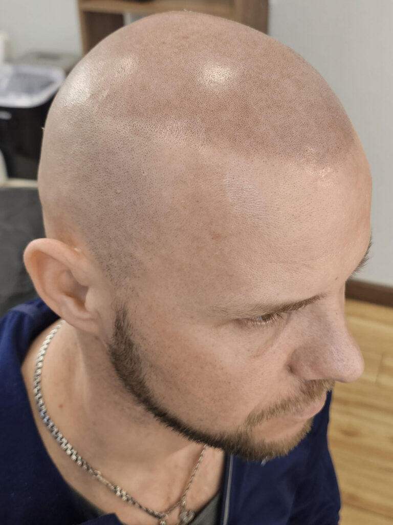Трихопигментация волос до и после процедуры — scalp micropigmentation