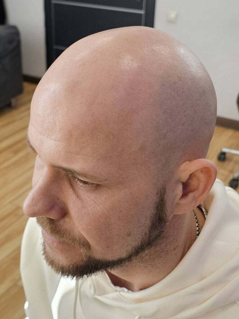 Трихопигментация волос до и после процедуры — scalp micropigmentation