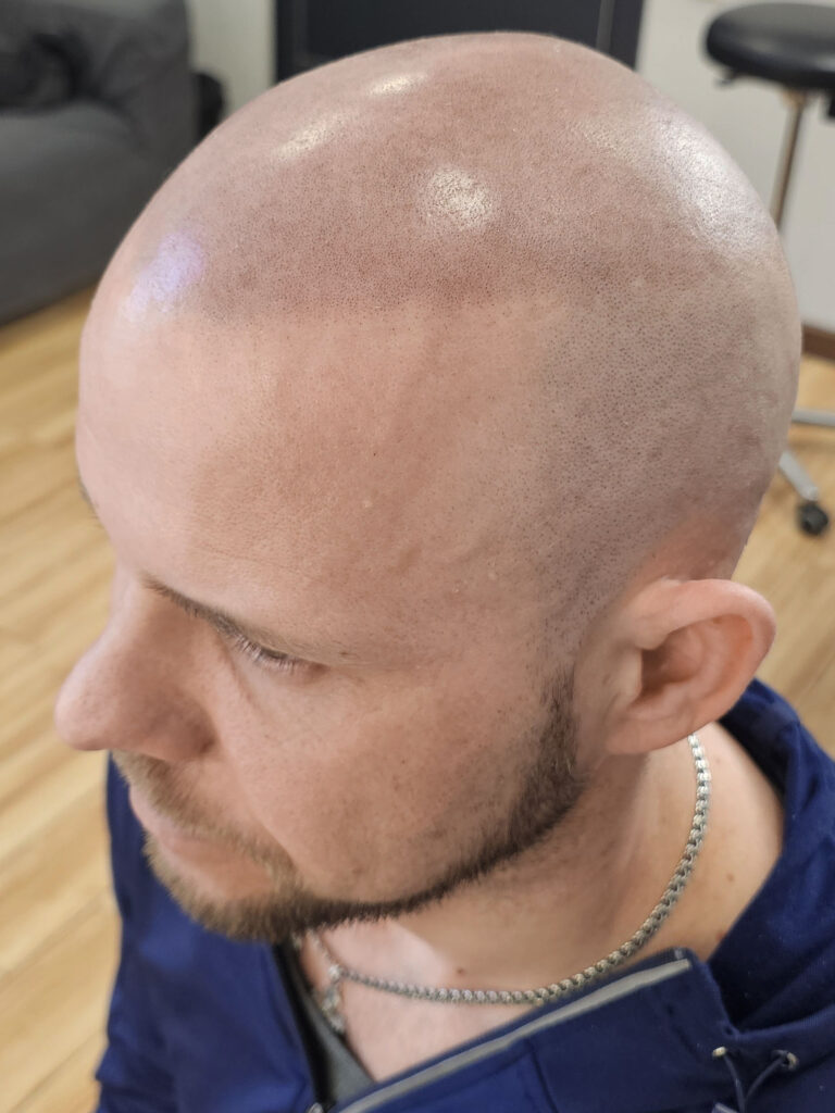 Трихопигментация волос до и после процедуры — scalp micropigmentation