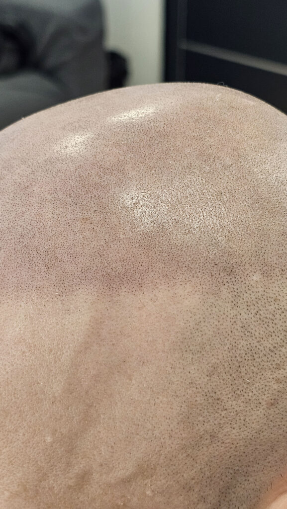 Трихопигментация волос до и после процедуры — scalp micropigmentation