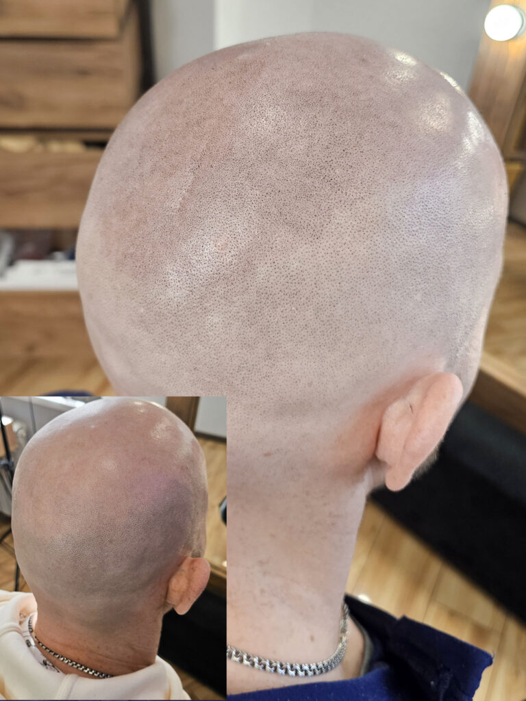 Трихопигментация волос до и после процедуры — scalp micropigmentation