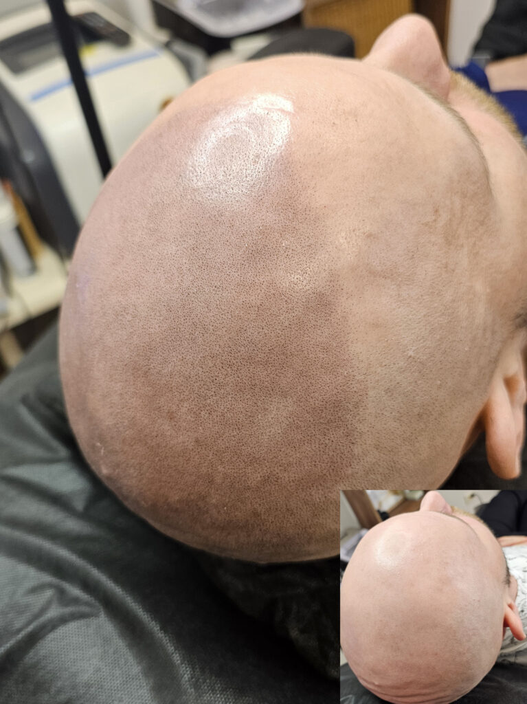 Трихопигментация волос до и после процедуры — scalp micropigmentation