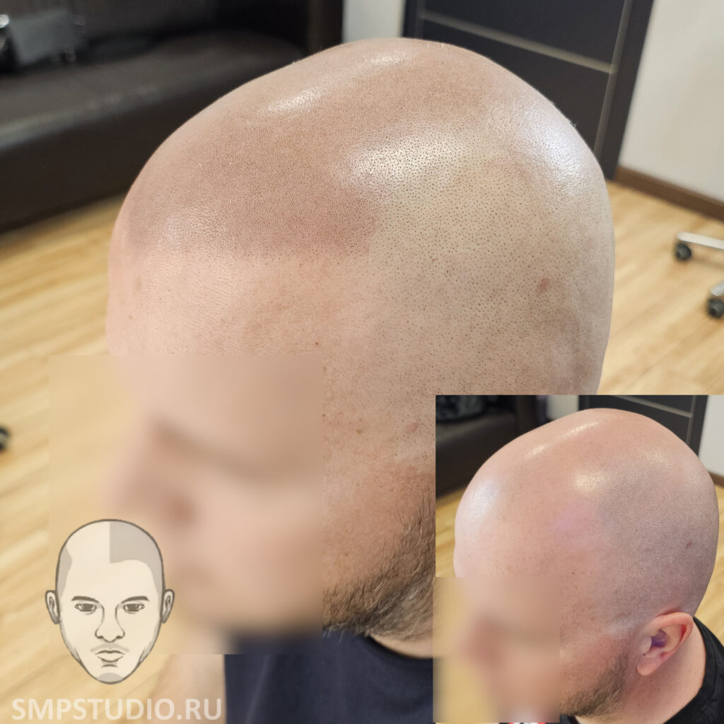 Трихопигментация волос до и после процедуры — scalp micropigmentation