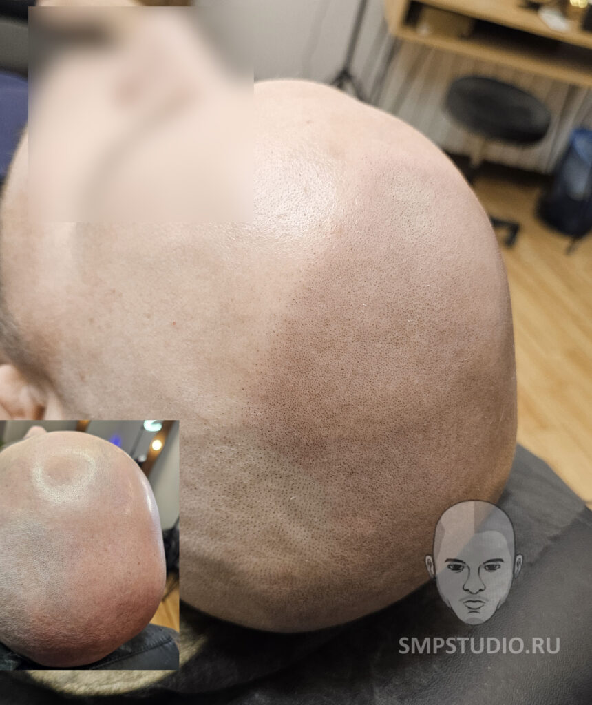 Трихопигментация волос до и после процедуры — scalp micropigmentation
