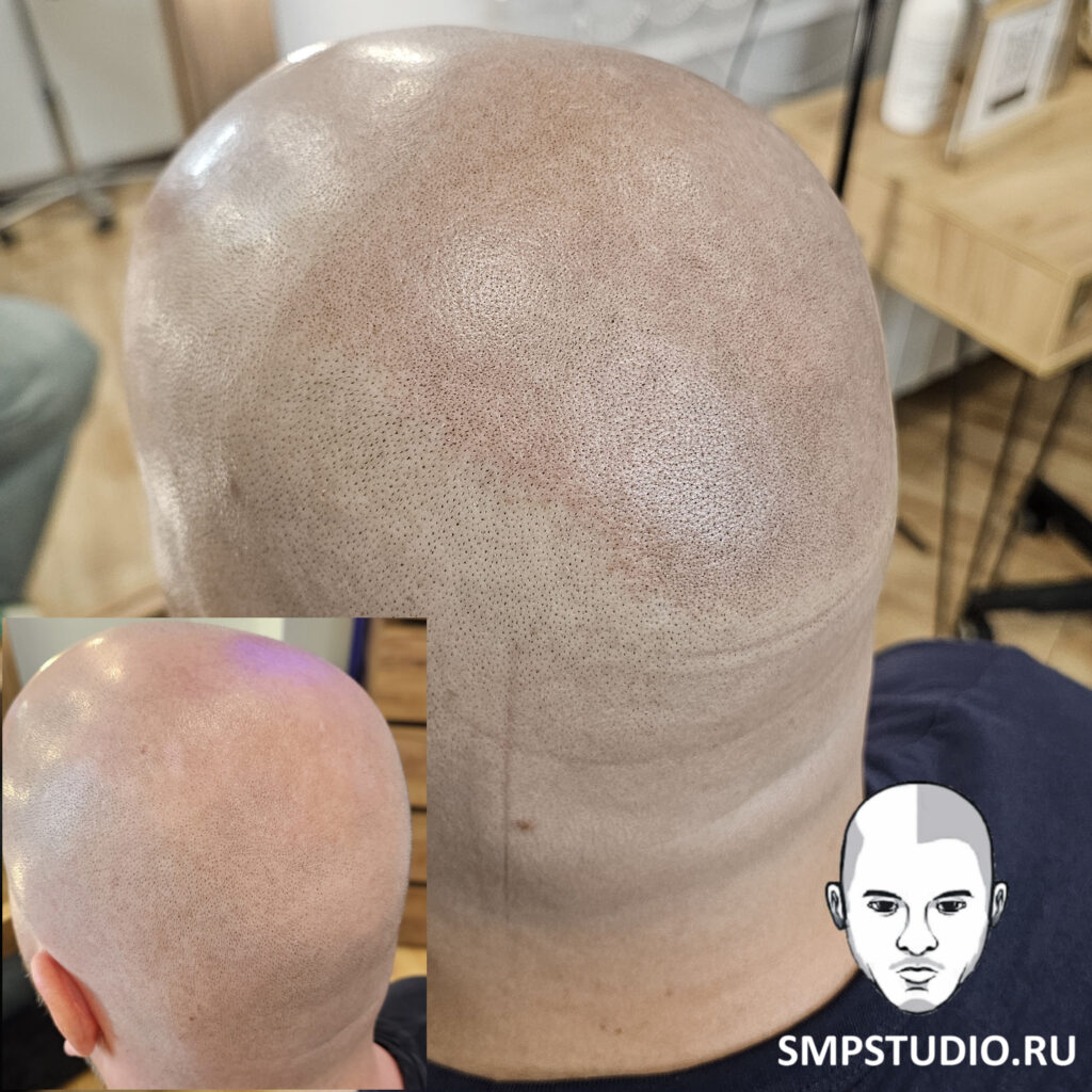 Трихопигментация волос до и после процедуры — scalp micropigmentation