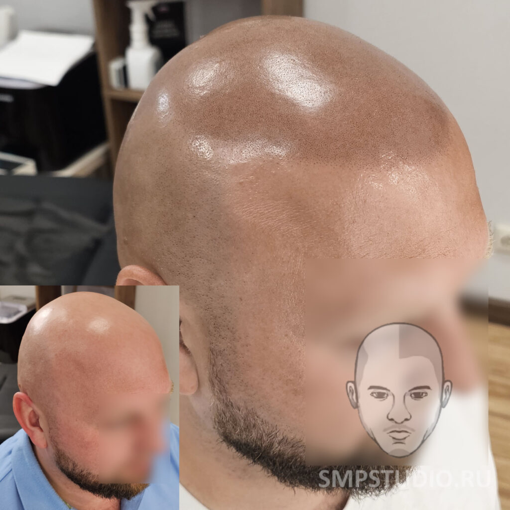 Трихопигментация волос до и после процедуры — scalp micropigmentation