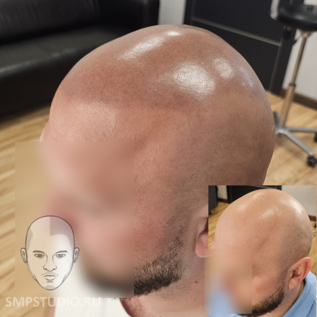 Трихопигментация волос до и после процедуры — scalp micropigmentation