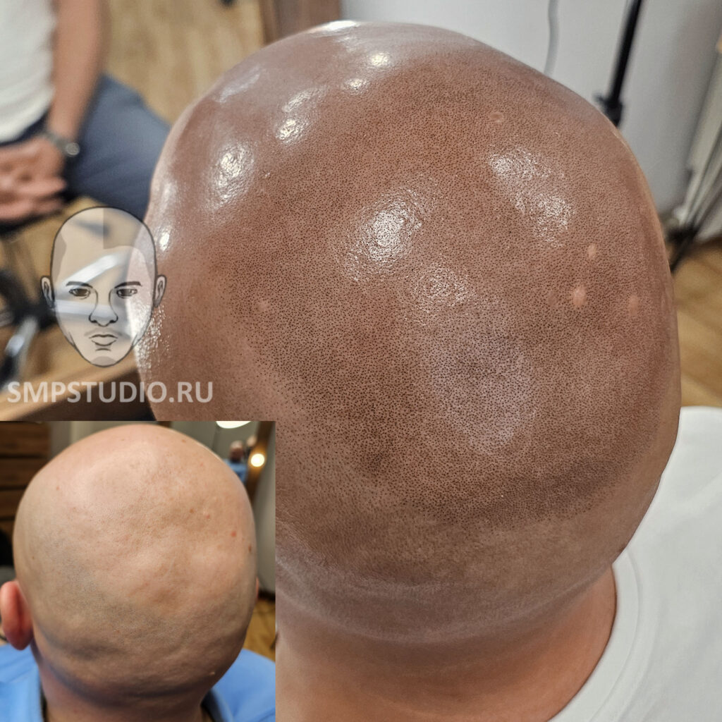 Трихопигментация волос до и после процедуры — scalp micropigmentation