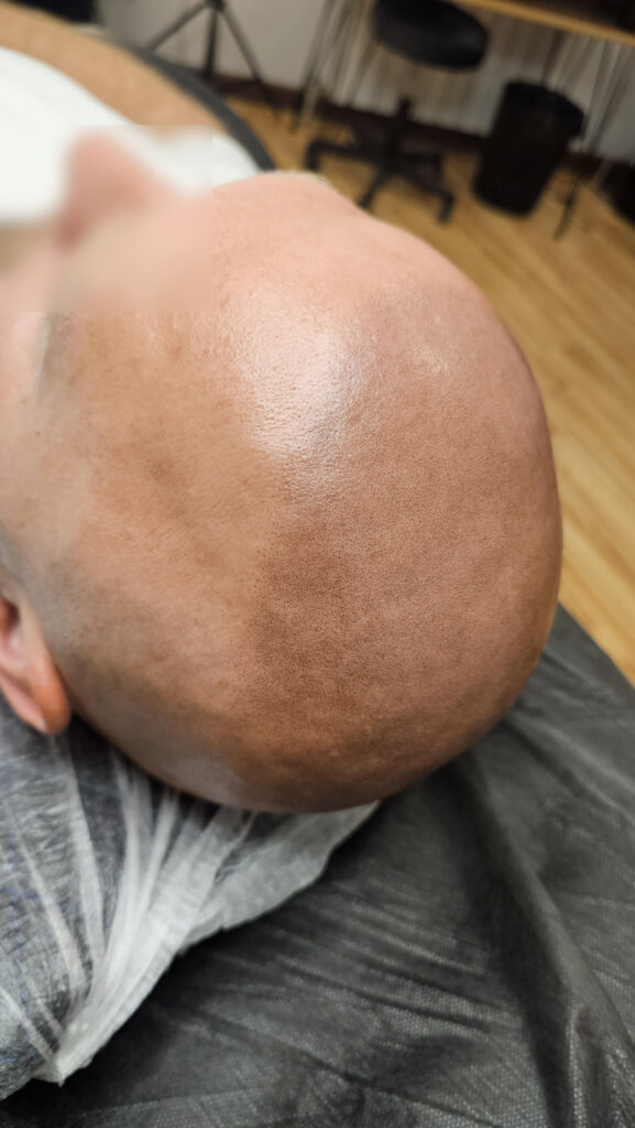 Трихопигментация волос до и после процедуры — scalp micropigmentation