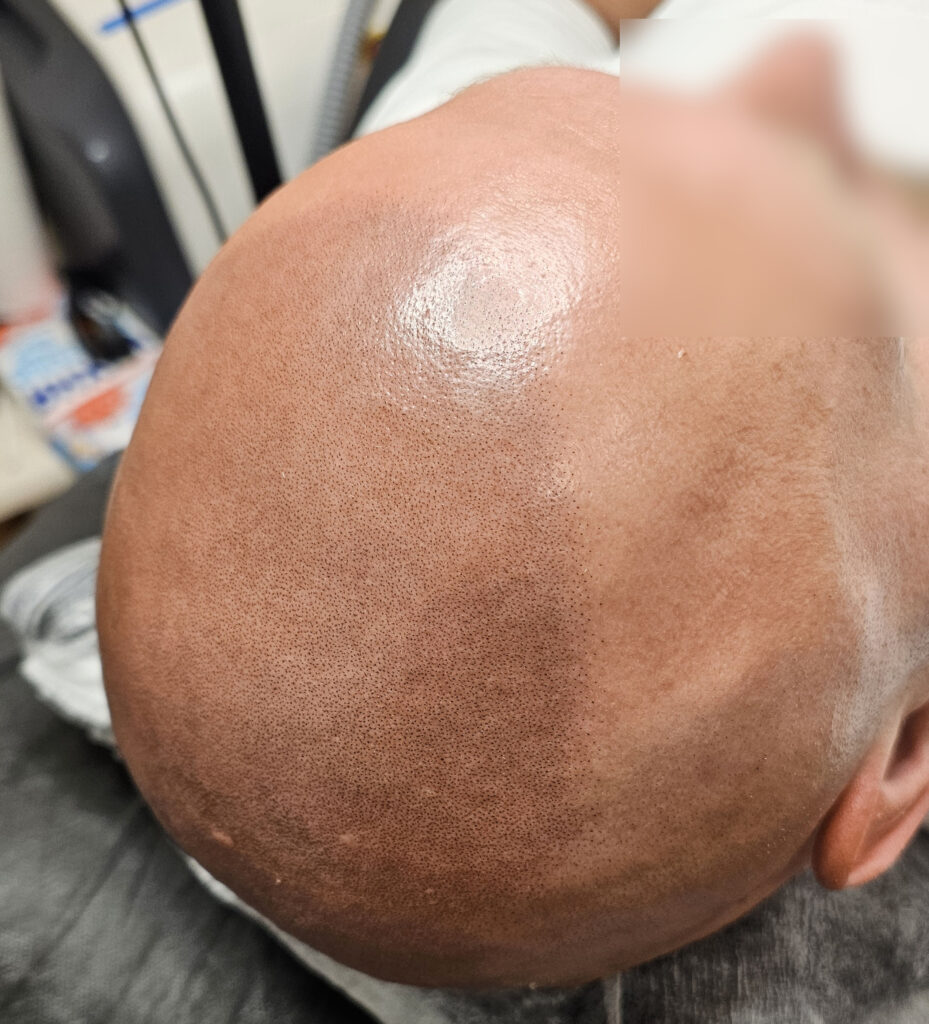 Трихопигментация волос до и после процедуры — scalp micropigmentation