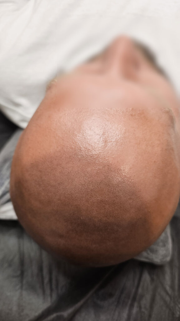 Трихопигментация волос до и после процедуры — scalp micropigmentation