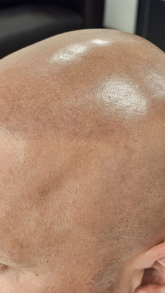 Трихопигментация волос до и после процедуры — scalp micropigmentation